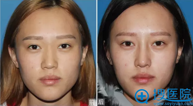 <!--<i data=20240710 data-id=11757></i>-->假体隆鼻真人案例正面对比效果图 <!--<i data=20240710 data-id=11757></i>-->假体隆鼻真人案例正面对比效果图