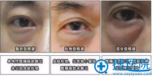 不同类型眼袋出现的原因 不同类型眼袋出现的原因
