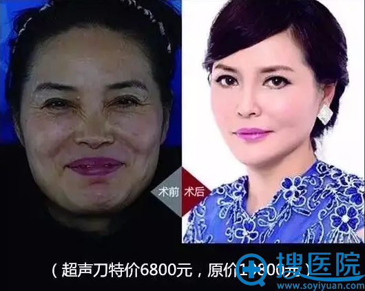 东莞美立方整形医院整形案例 东莞美立方整形医院整形案例