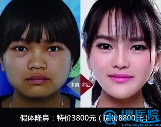 东莞美立方整形医院双眼皮整形案例 东莞美立方整形医院双眼皮整形案例