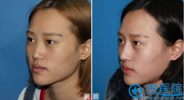 <!--<i data=20240710 data-id=11757></i>-->假体隆鼻真人案例侧面对比效果图 <!--<i data=20240710 data-id=11757></i>-->假体隆鼻真人案例侧面对比效果图