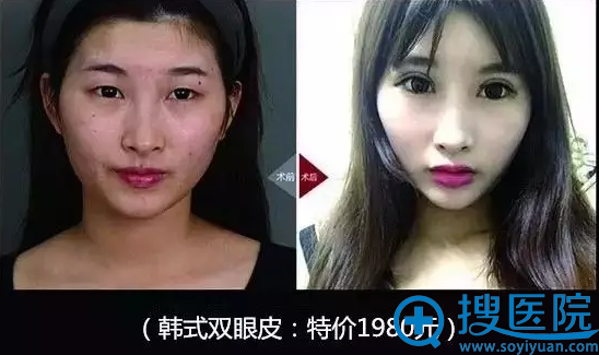 东莞美立方整形医院双眼皮整形案例 东莞美立方整形医院双眼皮整形案例
