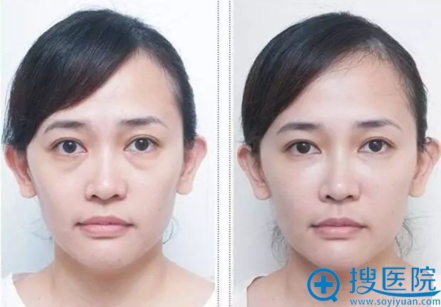 祛眼袋前后对比 祛眼袋前后对比