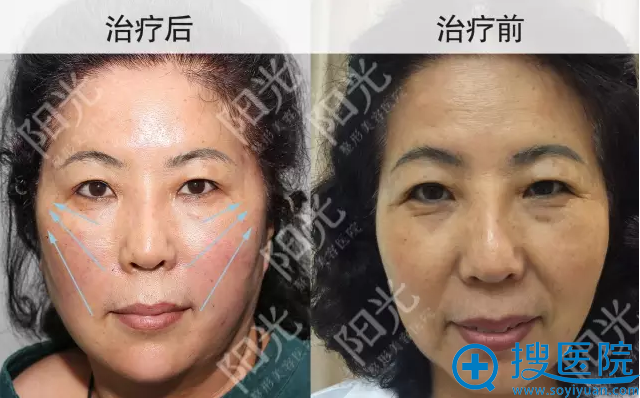 青春支架逆龄术效果对比案例 青春支架逆龄术效果对比案例