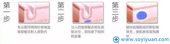 真皮深层及皮下组织层注射玻尿酸 真皮深层及皮下组织层注射玻尿酸