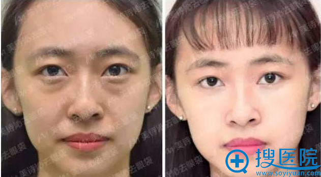 Anna不开刀去眼袋案例效果对比图 Anna不开刀去眼袋案例效果对比图