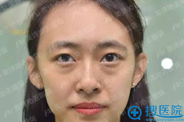 Anna去眼袋前照片 Anna去眼袋前照片