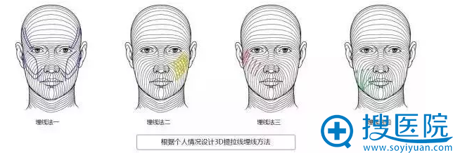 根据个人情况设计3d提拉埋线方法 根据个人情况设计3d提拉埋线方法