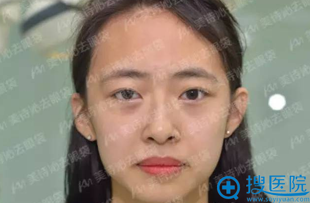 Anna刚做完眼袋治疗的效果 Anna刚做完眼袋治疗的效果