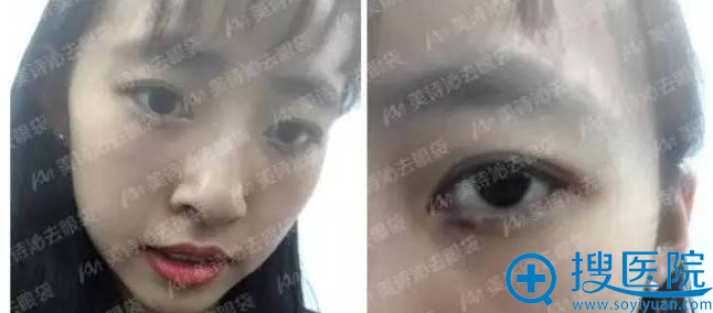 做完眼袋治疗后第二天,左眼仅出现轻微淤青 做完眼袋治疗后第二天,左眼仅出现轻微淤青