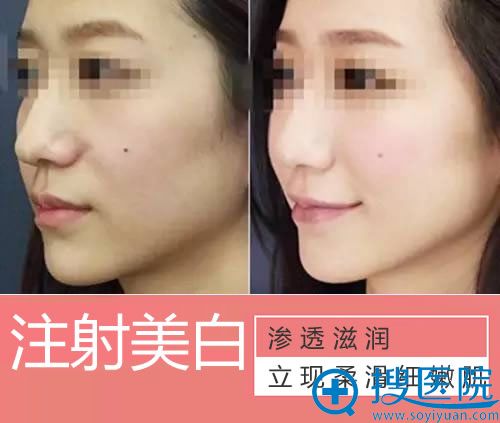 亚太整形注射美白案例效果图 亚太整形注射美白案例效果图