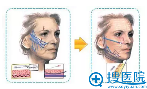 面部线雕提升示意图 面部线雕提升示意图