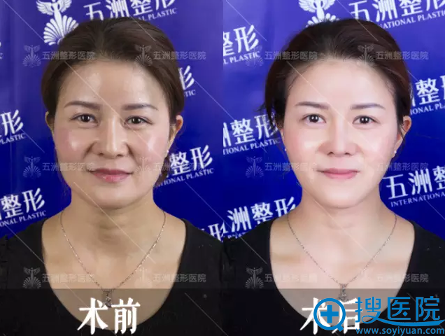 武汉五洲整形医院线雕隆鼻真人案例 武汉五洲整形医院线雕隆鼻真人案例
