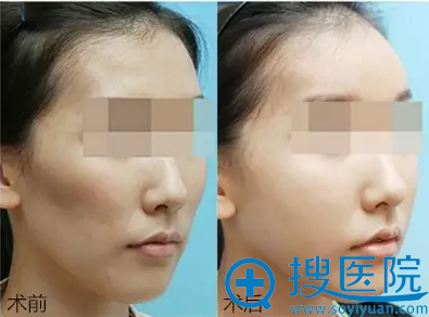 蛋白线雕作用于肌肉层,复位固定真人案例前后对比效果 蛋白线雕作用于肌肉层,复位固定真人案例前后对比效果