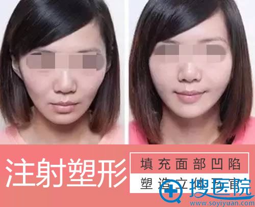 <!--<i data=20240710 data-id=9828></i>-->整形注射塑形案例效果图 <!--<i data=20240710 data-id=9828></i>-->整形注射塑形案例效果图