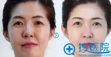 蛋白线雕作用于表皮层,提亮肤色案例图 蛋白线雕作用于表皮层,提亮肤色案例图