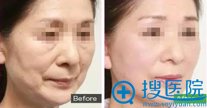蛋白线雕作用于皮下组织,支撑充盈真人案例展现 蛋白线雕作用于皮下组织,支撑充盈真人案例展现