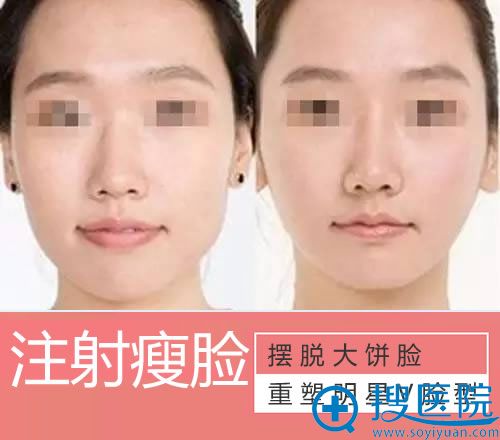 亚太整形注射瘦脸案例对比图 亚太整形注射瘦脸案例对比图