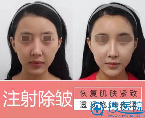 <!--<i data=20240710 data-id=9828></i>-->整形注射除皱案例效果图 <!--<i data=20240710 data-id=9828></i>-->整形注射除皱案例效果图