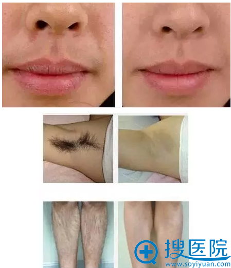 时光整形脱毛案例 时光整形脱毛案例