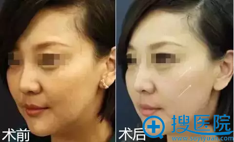 蛋白线雕作用于韧带结构,紧致弹性效果案例展示 蛋白线雕作用于韧带结构,紧致弹性效果案例展示