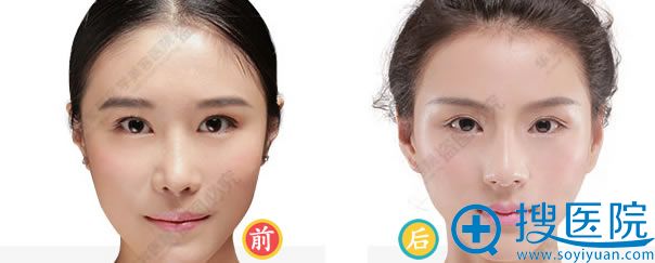 <!--<i data=20240710 data-id=16060></i>-->整形双眼皮开眼角案例 <!--<i data=20240710 data-id=16060></i>-->整形双眼皮开眼角案例