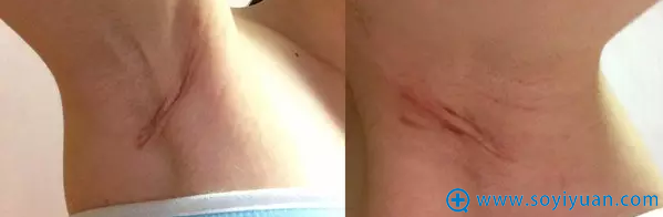 假体隆胸手术后1个月,腋下疤痕面积缩小 假体隆胸手术后1个月,腋下疤痕面积缩小