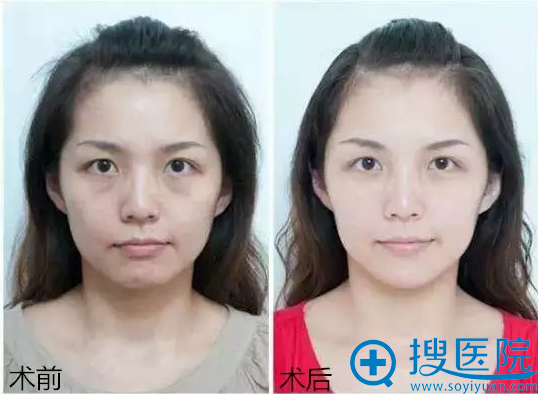 2、蛋白线雕作用于真皮层,胶原再生案例对比图 2、蛋白线雕作用于真皮层,胶原再生案例对比图