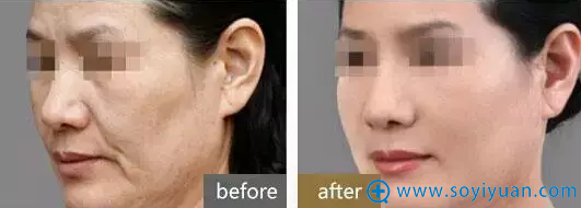 蛋白线雕作用于SMAS筋膜后深层提拉案例对比图 蛋白线雕作用于SMAS筋膜后深层提拉案例对比图