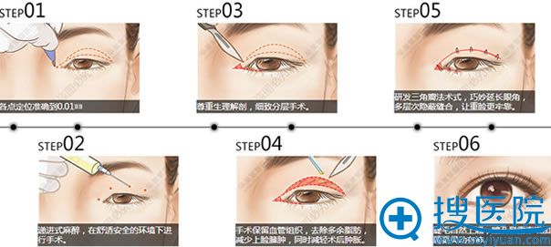 <!--<i data=20240710 data-id=16060></i>-->双眼皮+开眼角手术步骤 <!--<i data=20240710 data-id=16060></i>-->双眼皮+开眼角手术步骤