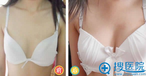 <!--<i data=20240710 data-id=12477></i>-->整形隆胸案例对比图 <!--<i data=20240710 data-id=12477></i>-->整形隆胸案例对比图