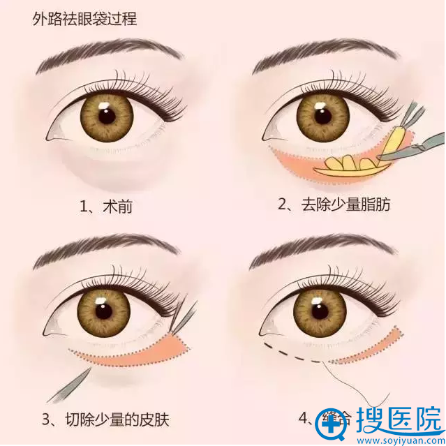 外切祛眼袋手术过程3d示意图 外切祛眼袋手术过程3d示意图