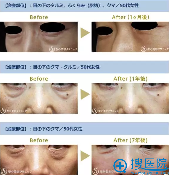 日本圣心医疗美容医院PRP治疗眼下凹陷对比照片 日本圣心医疗美容医院PRP治疗眼下凹陷对比照片