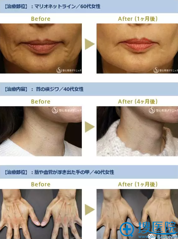 日本圣心医疗美容医院PRP治疗木偶线、颈项纹、手背对比照片 日本圣心医疗美容医院PRP治疗木偶线、颈项纹、手背对比照片