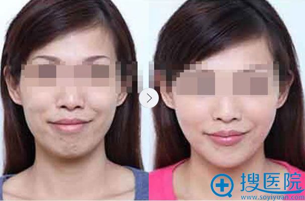 美基元双F冻龄线活力术案例图 美基元双F冻龄线活力术案例图