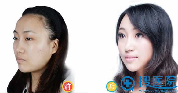 <!--<i data=20240710 data-id=12477></i>-->韩式双眼皮+开眼角案例图 <!--<i data=20240710 data-id=12477></i>-->韩式双眼皮+开眼角案例图