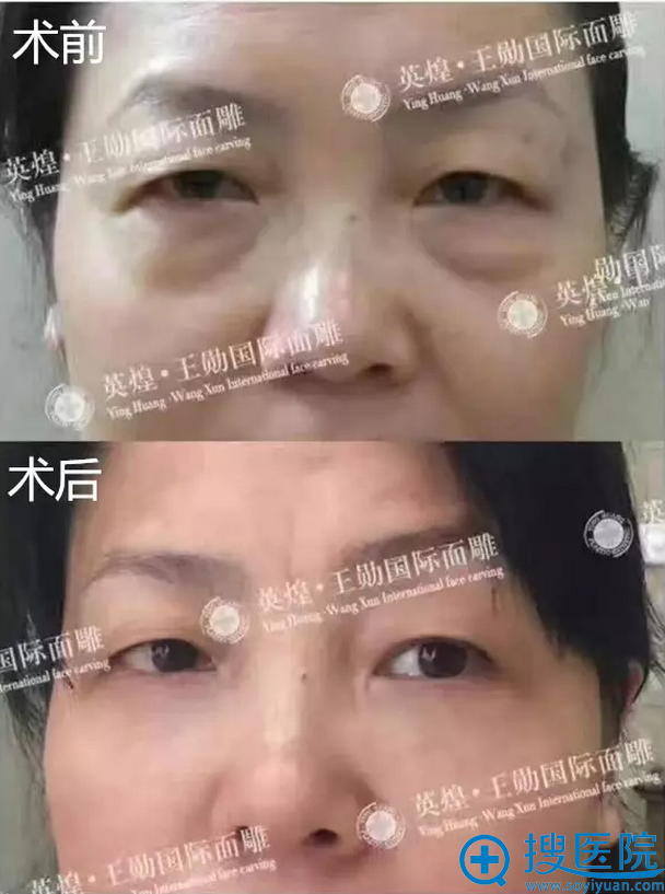 北京英煌整形医院王勋院长祛眼袋真人案例 北京英煌整形医院王勋院长祛眼袋真人案例