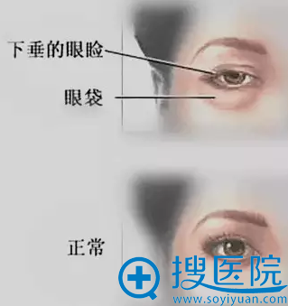 面部眼袋位置示意图 面部眼袋位置示意图