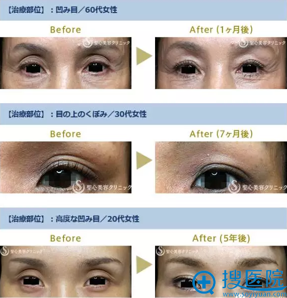 日本圣心医疗美容医院PRP治疗眼周凹陷对比照片 日本圣心医疗美容医院PRP治疗眼周凹陷对比照片