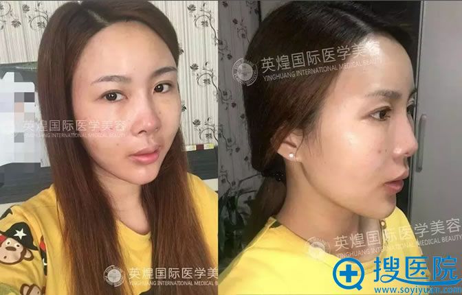 王勋院长为我做脂肪面部填充第二天 王勋院长为我做脂肪面部填充第二天