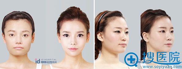 韩国磨骨瘦脸贵不贵?韩国ID整形磨骨方式+案例效果+手术价格