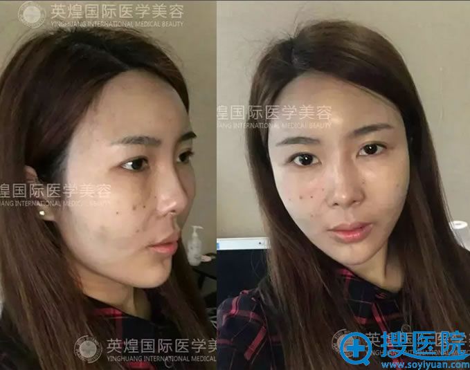 自体脂肪面部填充术后天效果 自体脂肪面部填充术后天效果