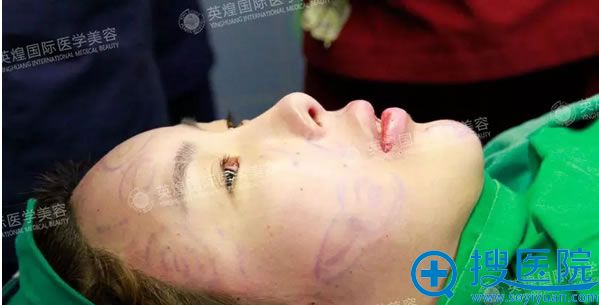 自体脂肪面部填充手术即刻效果 自体脂肪面部填充手术即刻效果