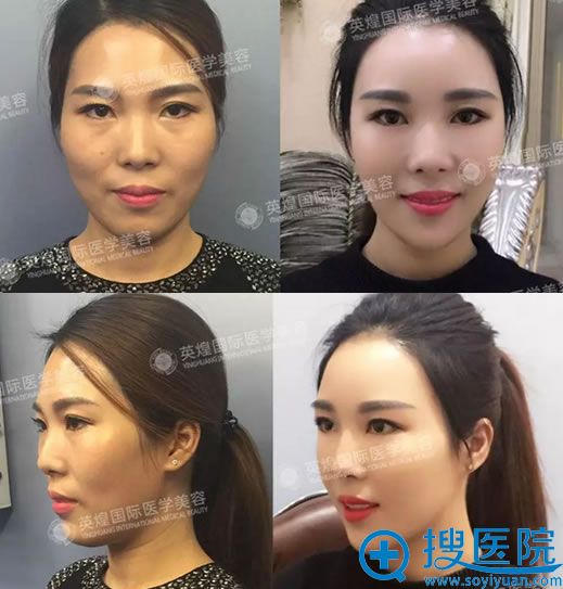 较后看看我的术前术后对比照 较后看看我的术前术后对比照