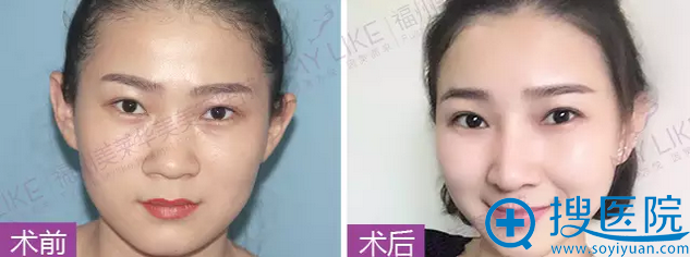 美莱华美员工真实美鼻案例 美莱华美员工真实美鼻案例