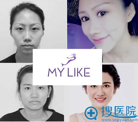 上海美莱整形案例效果图 上海美莱整形案例效果图