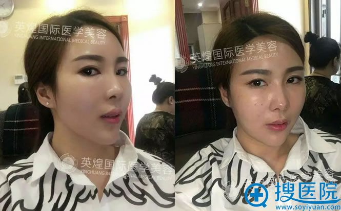 后两个月了,面部基本恢复 后两个月了,面部基本恢复