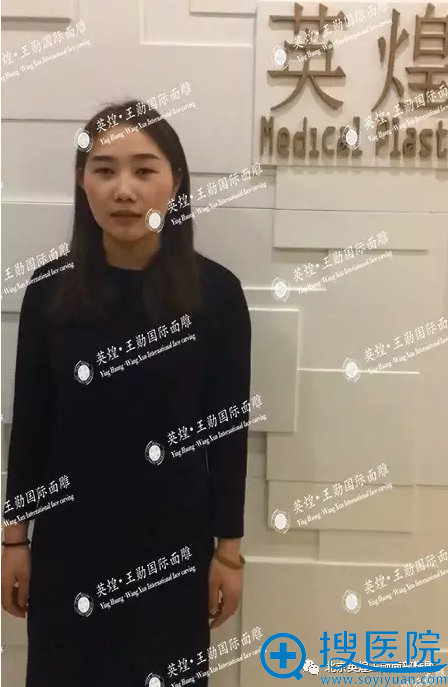 分享我在北京英煌找王勋院长做假体隆鼻+双眼皮手术的真实经历