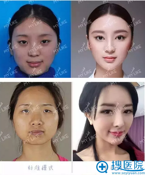 四川美莱整形医院双眼皮整形前后对比照 四川美莱整形医院双眼皮整形前后对比照