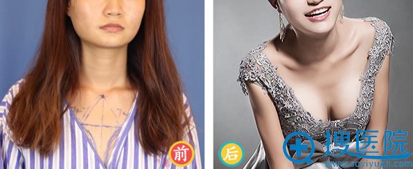 假体隆胸案例_深圳非凡整形 假体隆胸案例_深圳非凡整形
